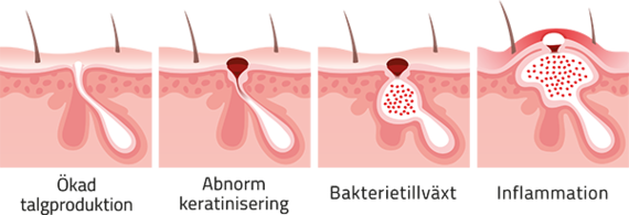 Behandling av fyra orsaker till akne