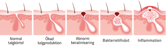 Fyra orsaker till att man får finnar