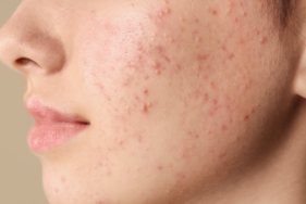 Lindrig akne