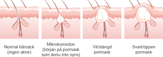 Pormaskar (olika stadier)