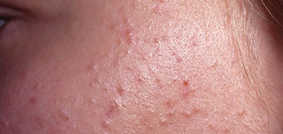 Stängda pormaskar på kind