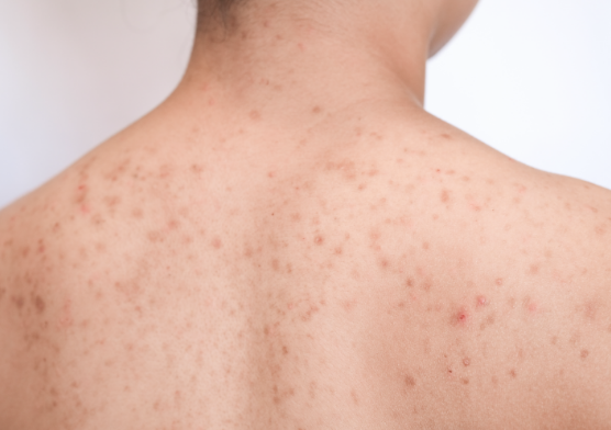 scratching-pimples-on