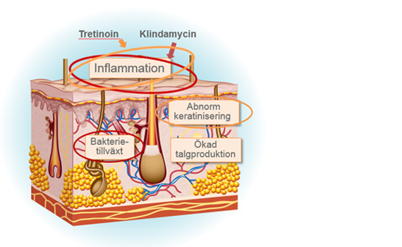 Acnatac - Klindamycin och tretinoin