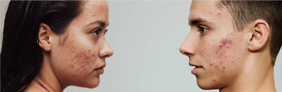 Behöver din akne behandling?