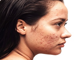 Behöver din akne behandling?