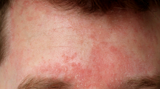 Rosacea